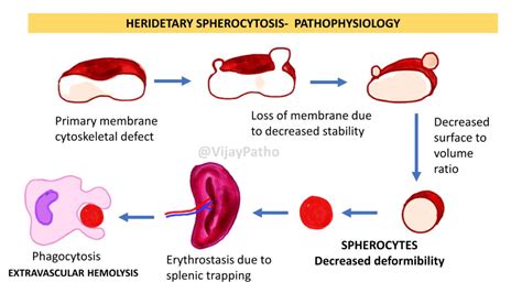 hereditary elliptocytosis life expectancy|Hereditary Spherocytosis and Hereditary Elliptocytosis.